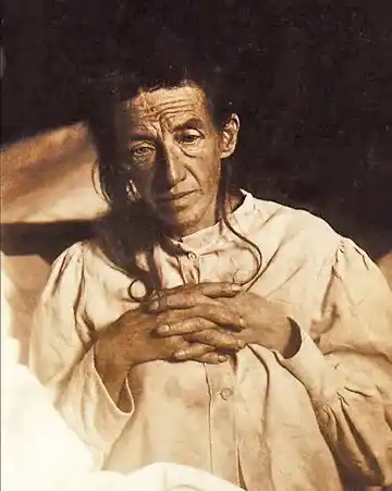 Picture of Auguste D aus Marktbreit first described patient with Alzheimer's Disease